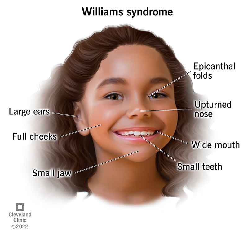 Williams syndrome