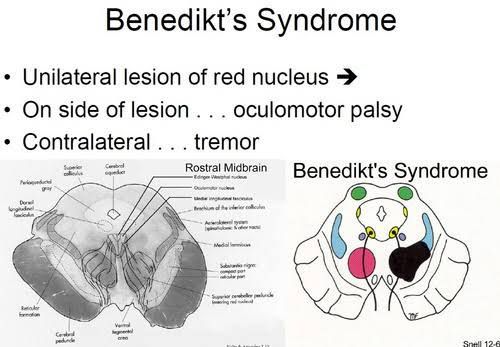 Benedikt syndrome